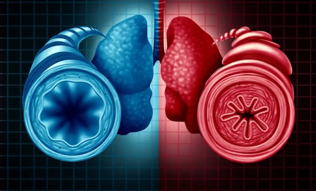 Normal Airway vs Asthma Airway